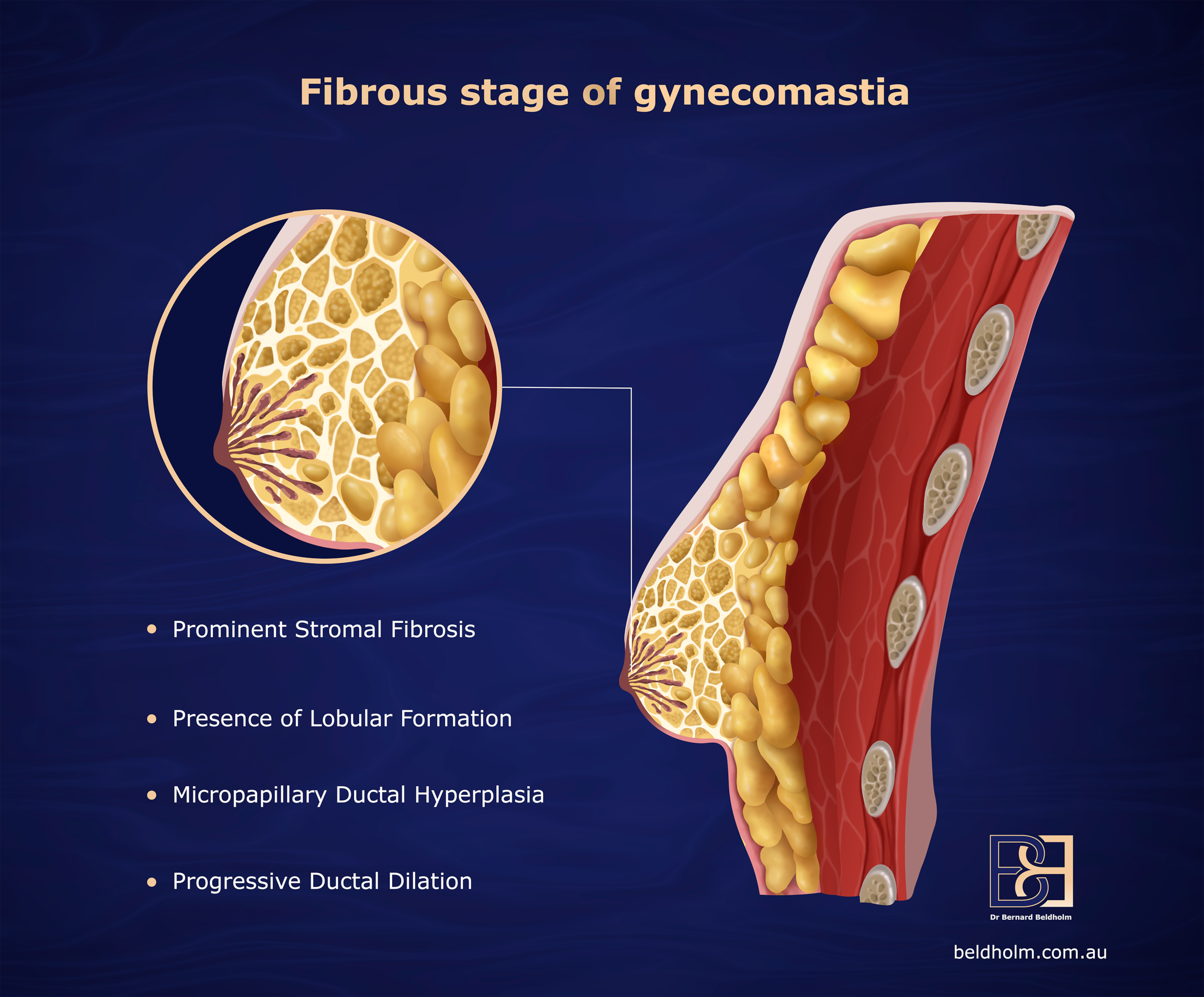 fibrous stage of gynecomastia | Dr Beldholm