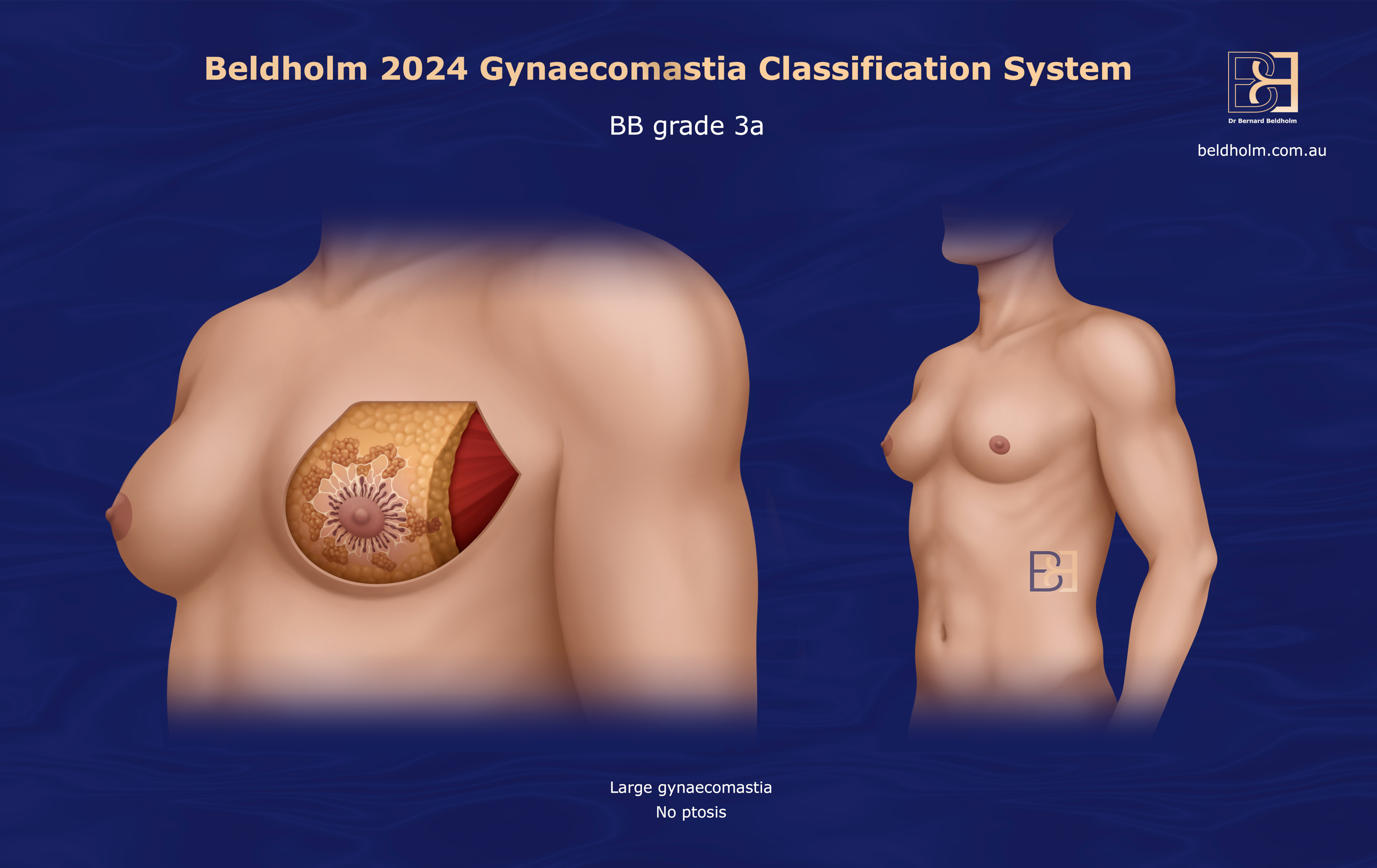 BB Grade 3a gynaecomastia | Dr Beldholm