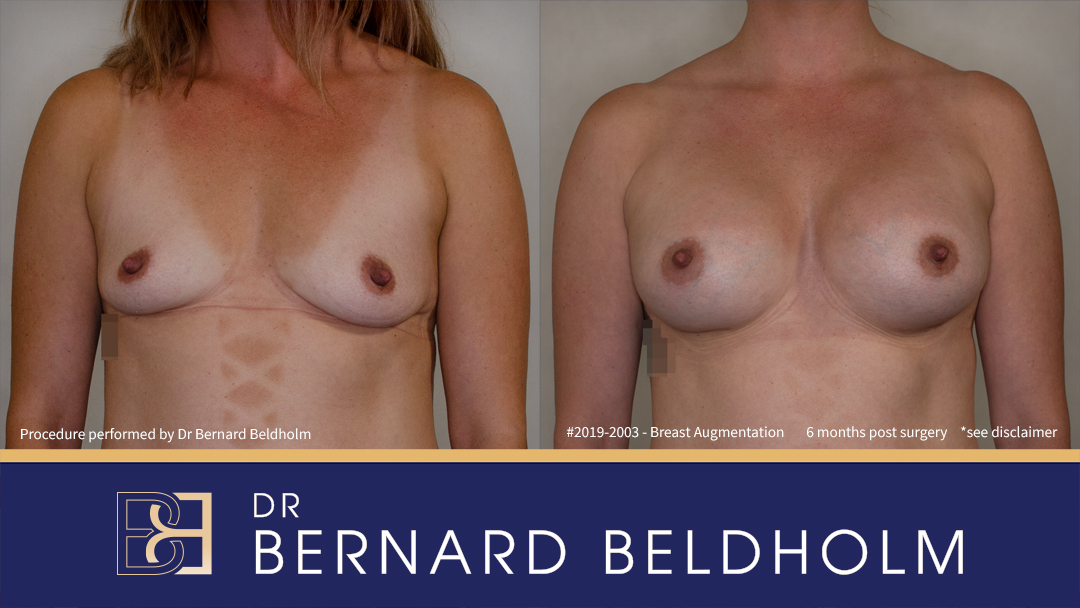 400cc Silicone Round Breast Implants (Augmentation Mammaplasty) {Patient 2019-2003} Before & After - Front