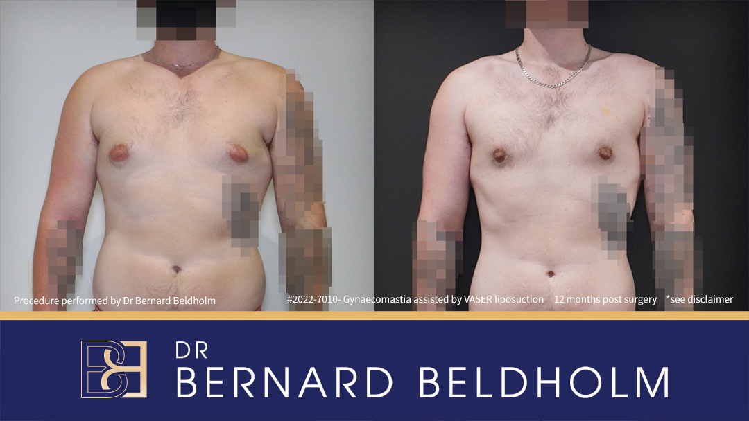 Patient 2022-7010 Gynaecomastia: VASER Liposuction + Gland Excision [BB grade 2a] Before & After - Front