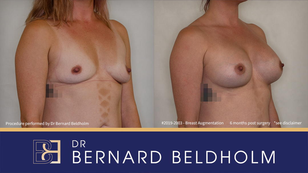 400cc Silicone Round Breast Implants (Augmentation Mammaplasty) {Patient 2019-2003} Before & After - Left