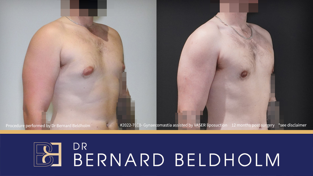 Patient 2020-7010 Gynaecomastia: VASER Liposuction + Gland Excision [BB grade 2a] Before & After - Left