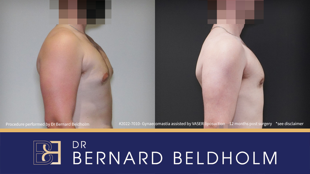 Patient 2020-7010 Gynaecomastia: VASER Liposuction + Gland Excision [BB grade 2a] Before & After - Side