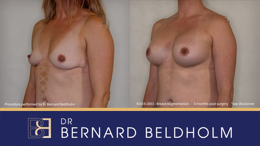 400cc Silicone Round Breast Implants (Augmentation Mammaplasty) {Patient 2019-2003} Before & After - Right