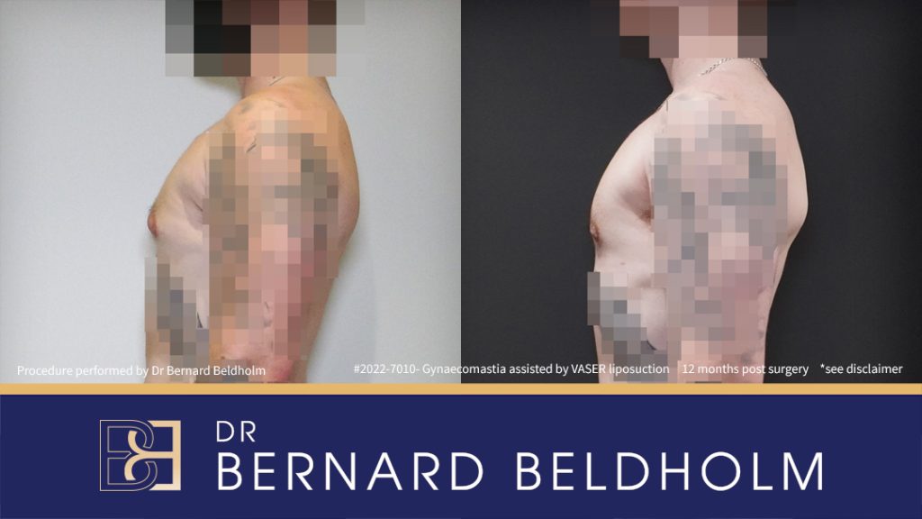 Patient 2020-7010 Gynaecomastia: VASER Liposuction + Gland Excision [BB grade 2a] Before & After - Right