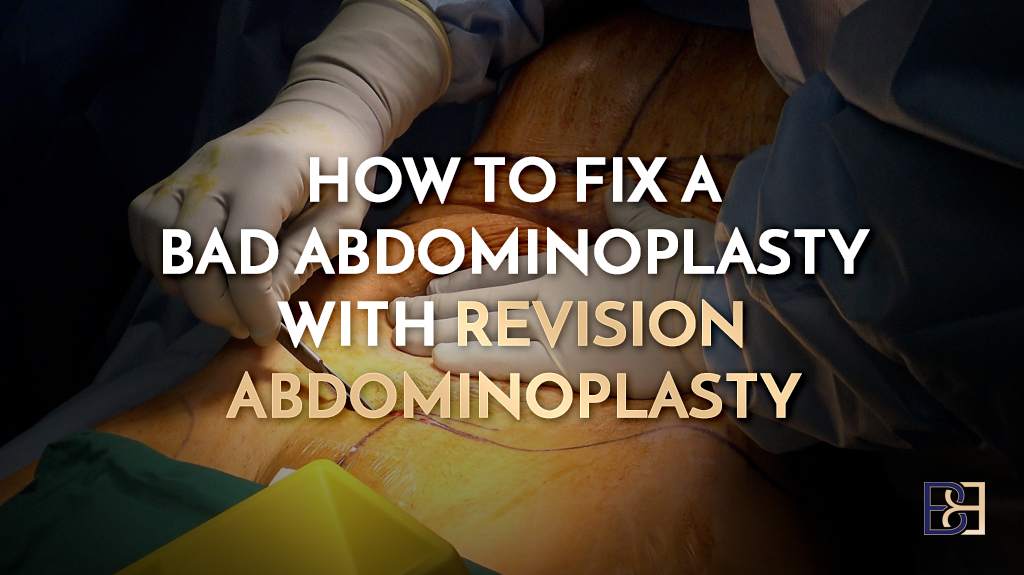 How to Fix a Bad Abdominoplasty with Revision Surgery