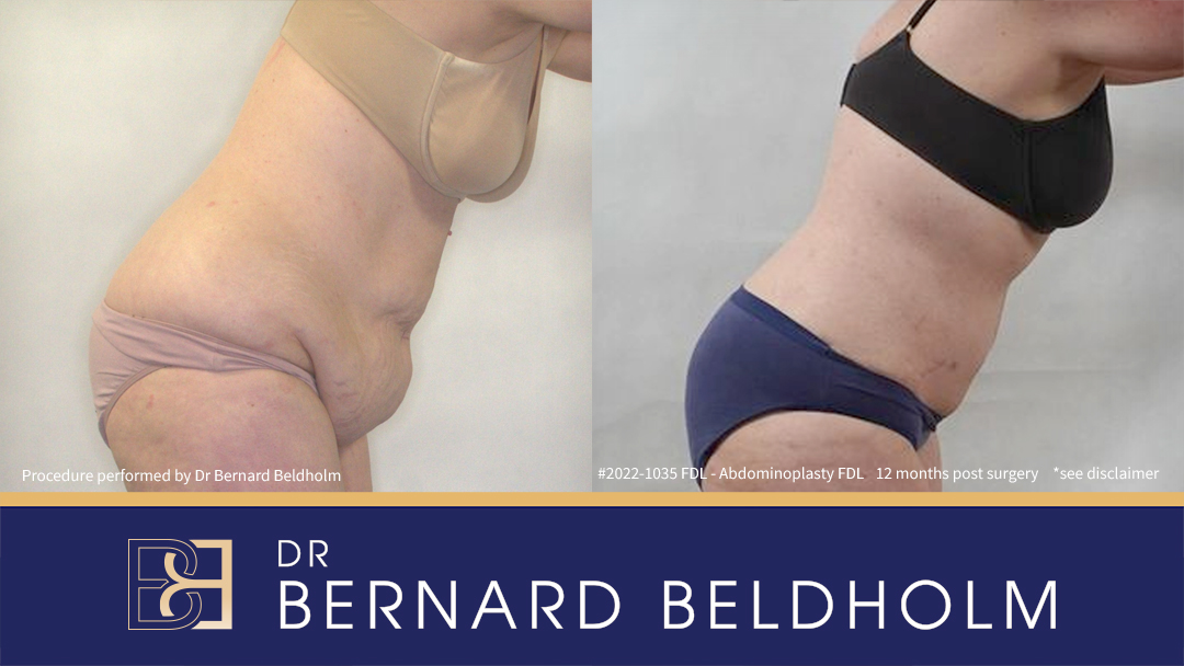 Patient 2022-1035 Fleur de Lis Abdominoplasty Including VASER Liposuction - Bend