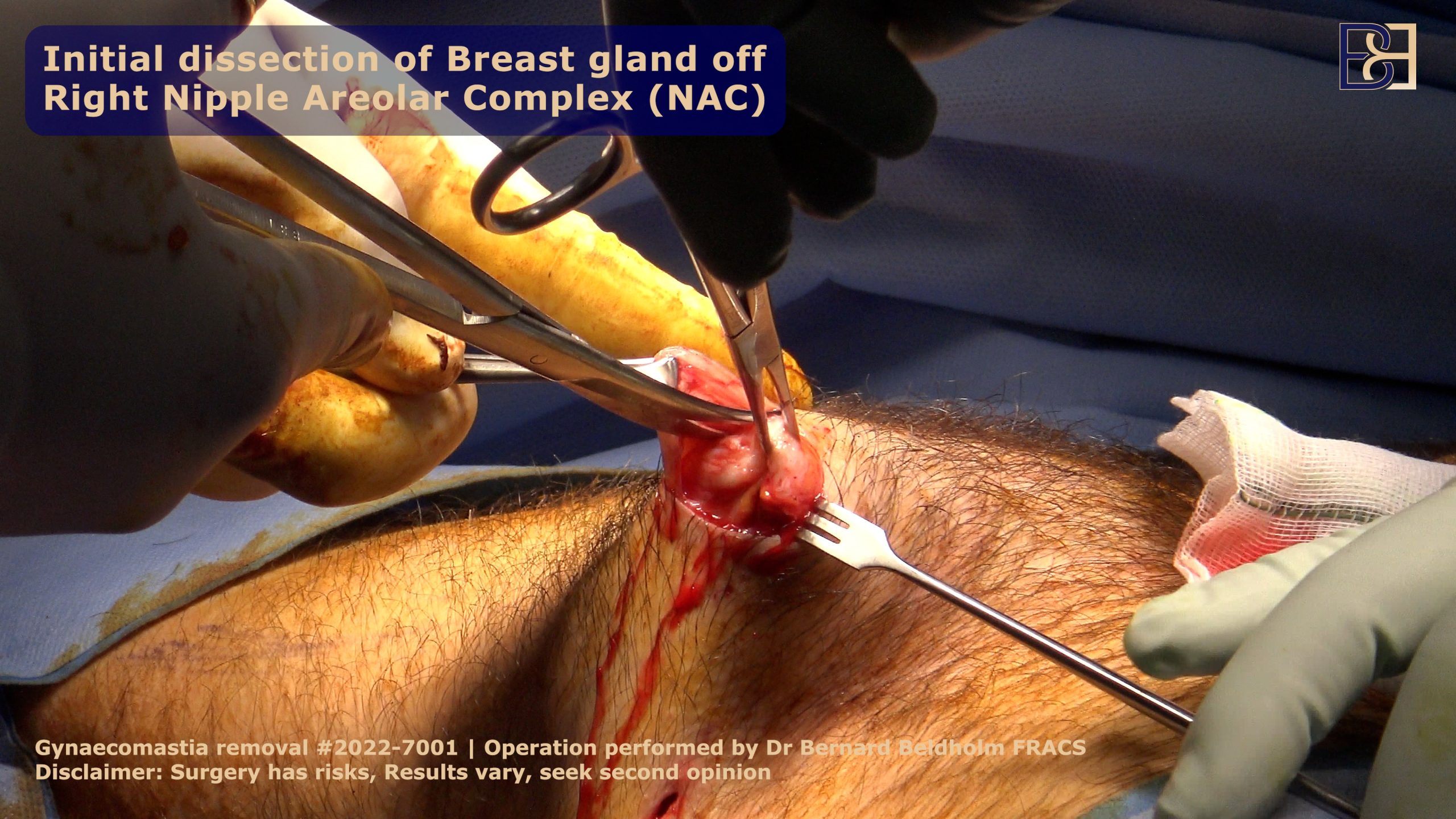 Removal of breast gland tissue though small sub-areolar incision | Dr Beldholm 