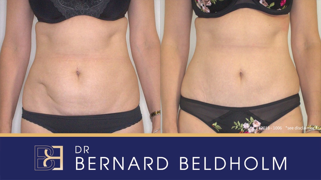 Teathered appendix scar repaired improved though a mini abdominoplasty with Dr Beldholm