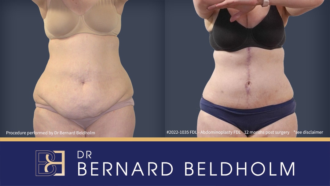 Fleur de lis abdominoplasty with VASER liposuction | Dr Beldholm