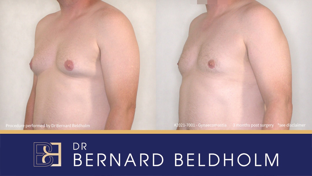 BB grade 2b gynaecomastia (Moderate Pseudo-gynaecoamstia) with a small gland component Before & After | Dr Beldholm