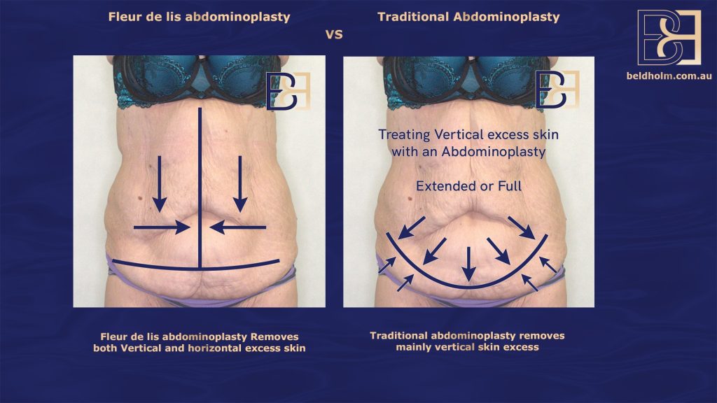 Comparing Traditional Abdominoplasty and Fleur de Lis Abdominoplasty