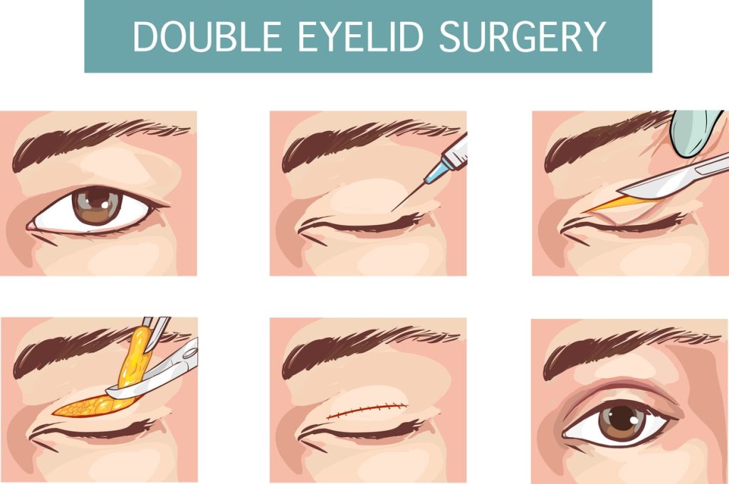 Double Eyelid Surgery