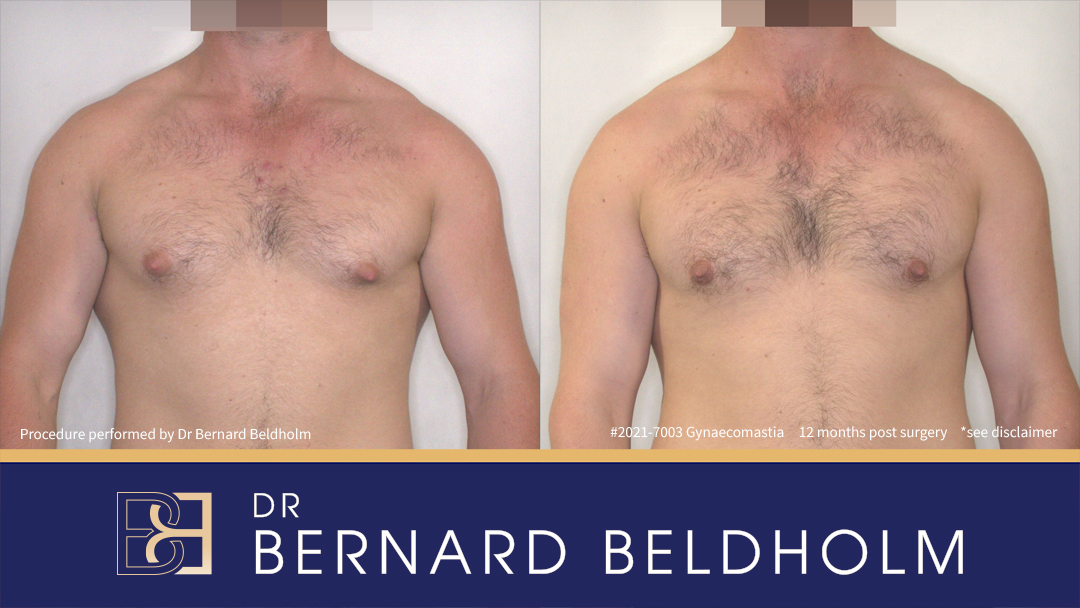 Patient 2021-7003 Gynaecomastia: Gland Excision & Liposuction [BB grade 1] Before & After 12 months Post Surgery