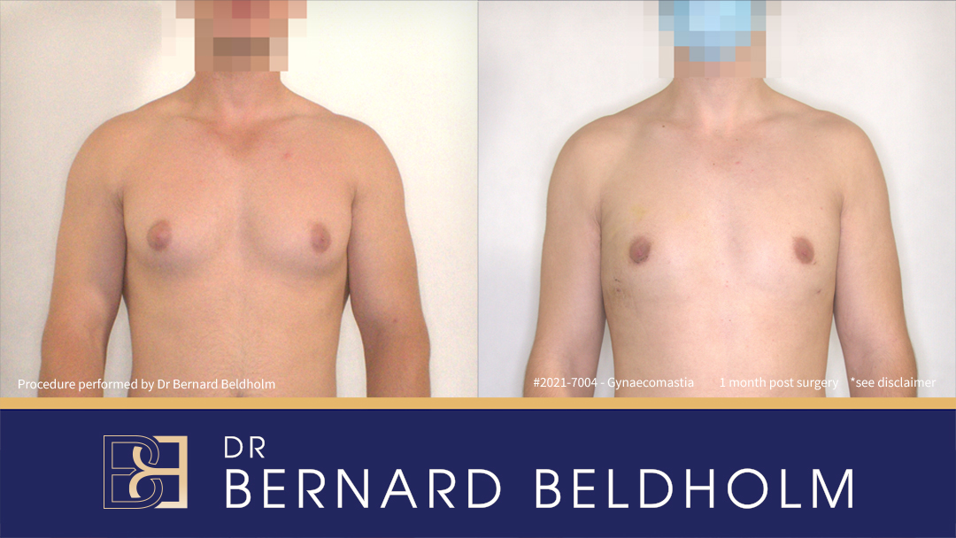 Patient 2021-7004 Large Gynaecomastia Treated with Excision of Gland & VASER Liposuction [BB grade 3a] Before & After 1 Month Post Surgery