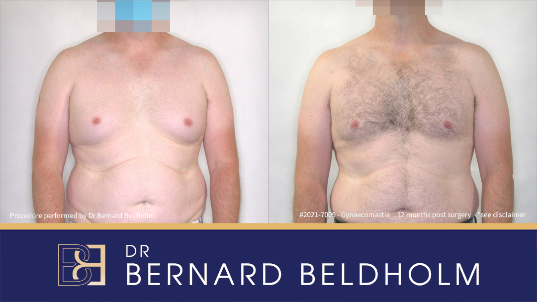 Patient 2021-7009 Pseudo-gynaecomastia with Small Amount of Gland [BB grade 2b] Before & After 12 Months Post Surgery