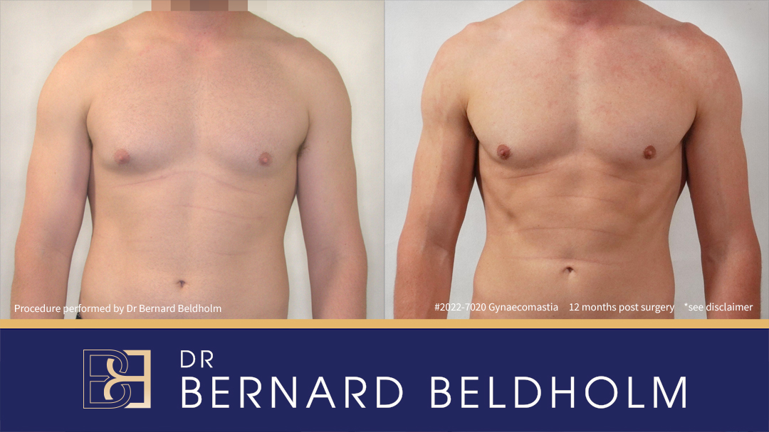 Patient 2022-7020 Moderate Gynaecomastia [BB grade 2a] Before & After 12 Months Post Surgery