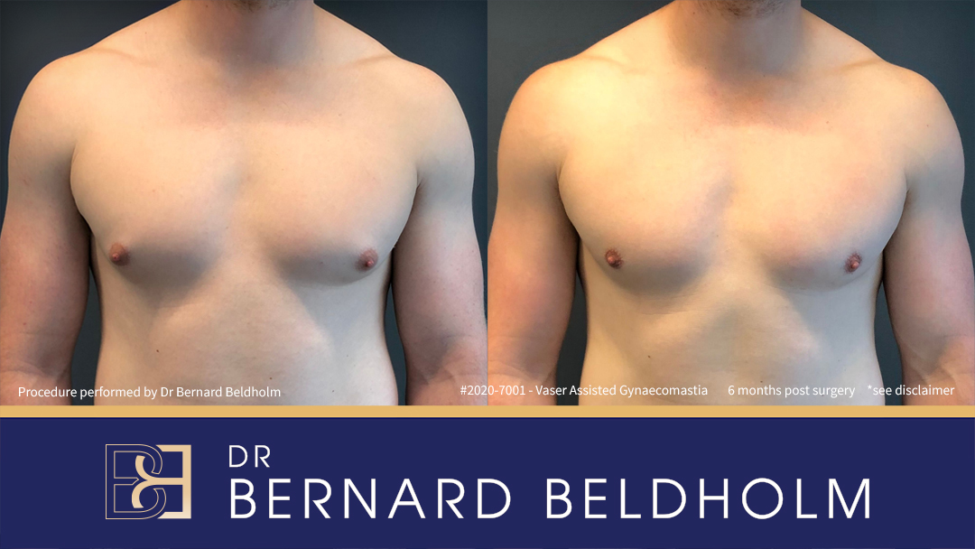 Patient 2020-7001 Gynaecomastia: Gland Excision & Liposuction [BB grade 2a] Before & After 6 Months Post Surgery