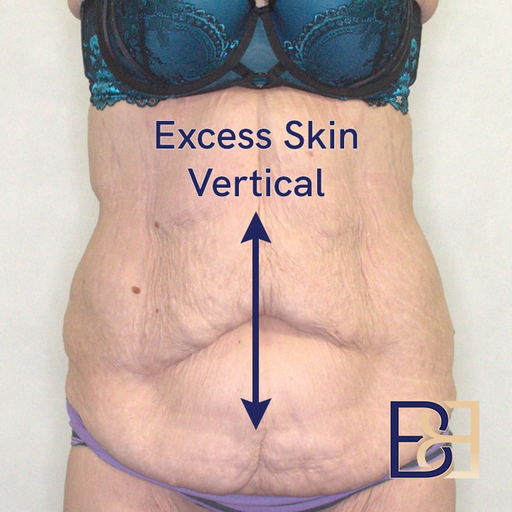 Excess skin in Vertical Direction Dr Beldholm