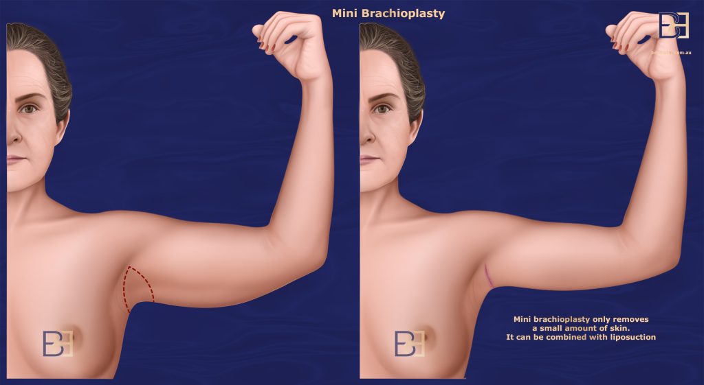 Mini Brachioplasty