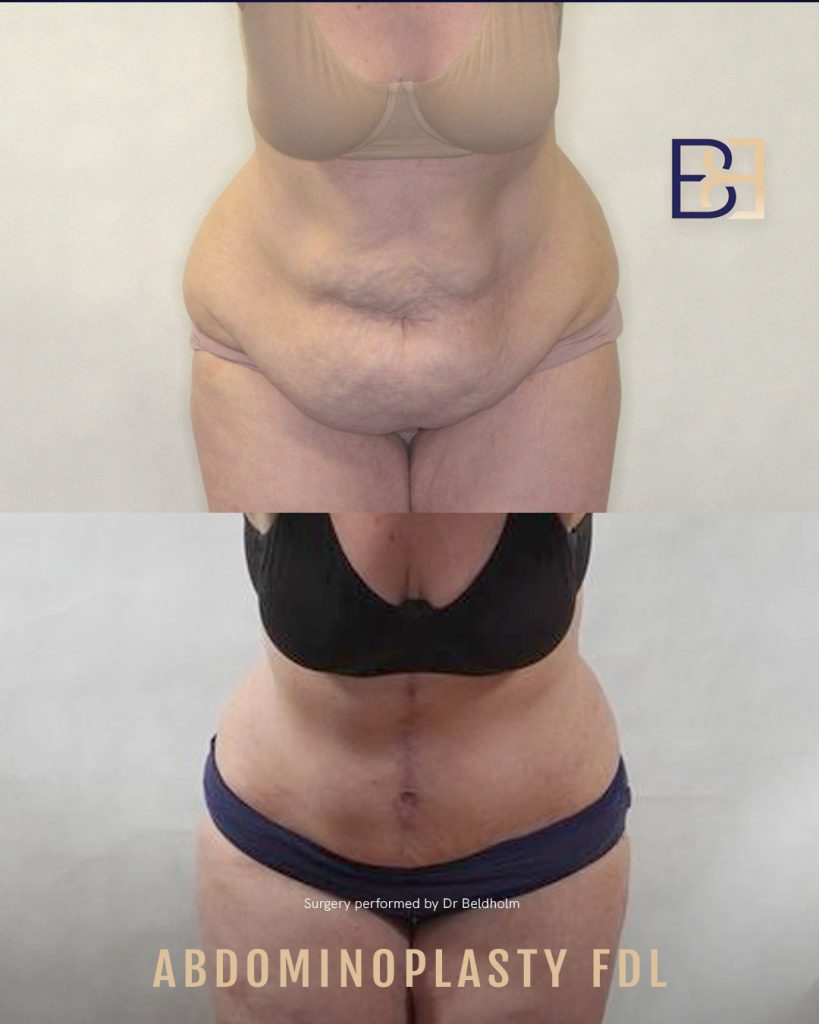 Removal of excess skin with Fleur de lis abdominoplasty