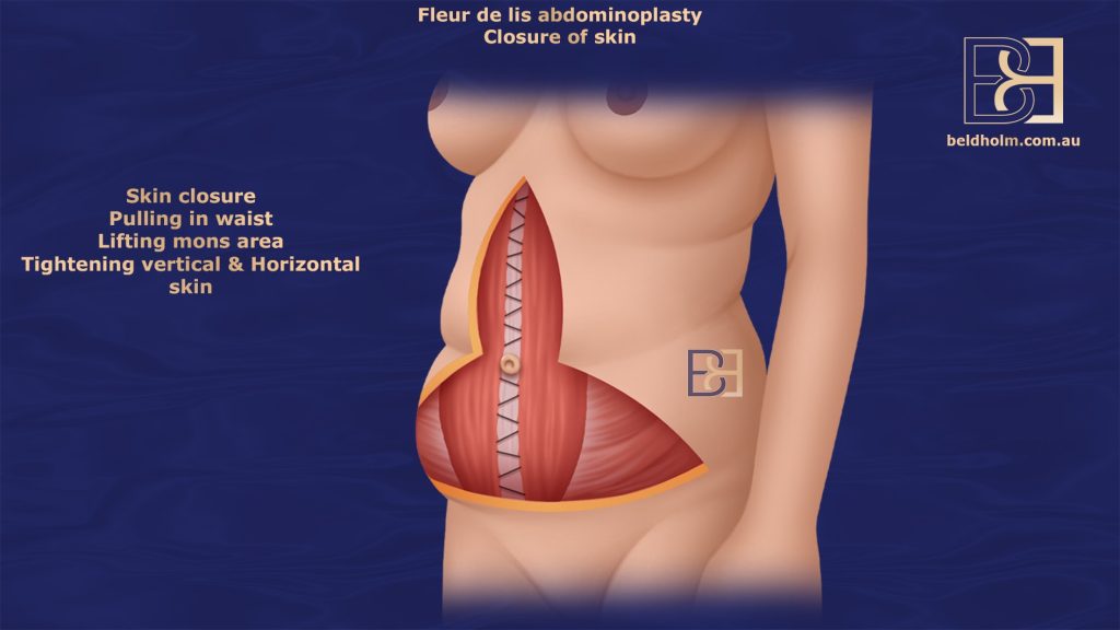 Skin Dissection and Umbilicus Management