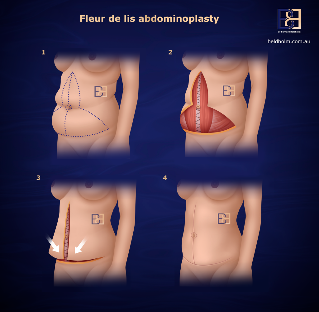 Understanding Fleur de Lis Abdominoplasty