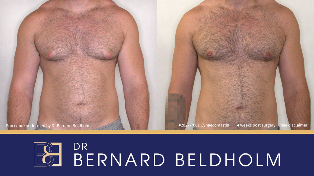 Patient 2022-7001 “Puffy Nipple” Gynaecomastia Since Starting Body Building 6 Years Prior Treated with Gland Excision and VASER Liposuction [BB grade 1] Before & After 4 weeks Post Surgery