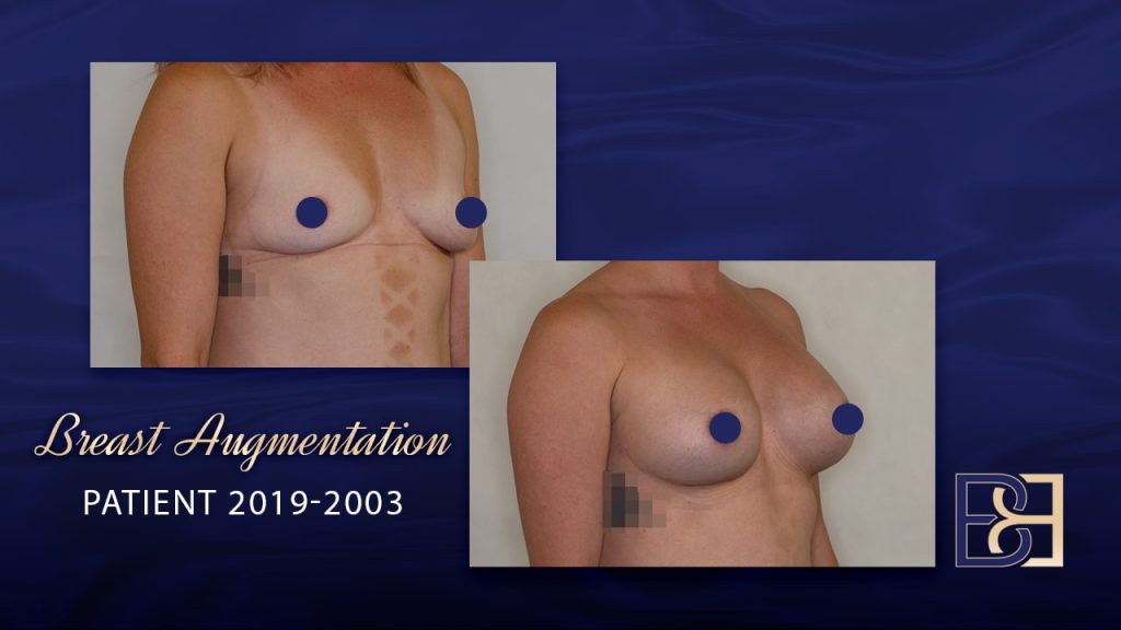 Breast Implants 9 Breast Augmentation with Dr Beldholm
