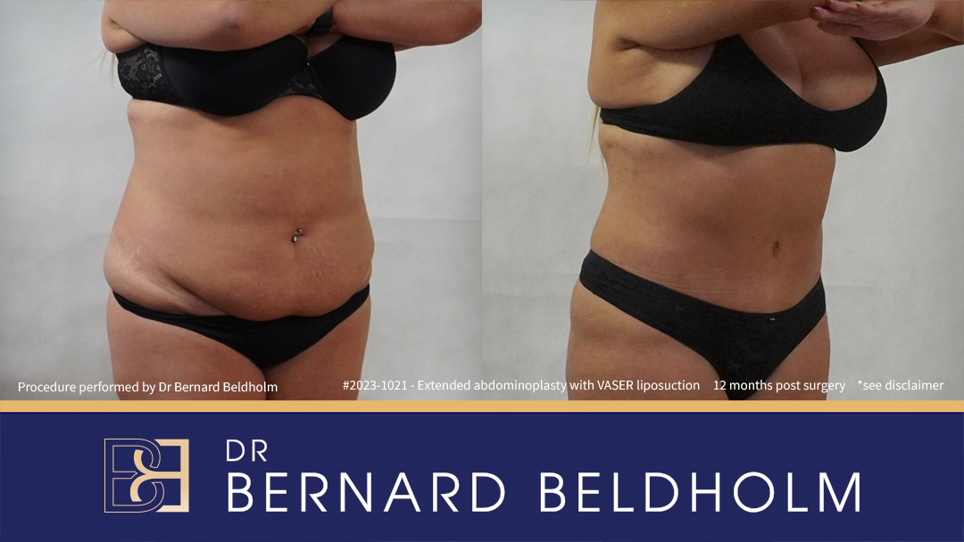Abdominoplasty Post Weight Loss Patient 2023-1021 1 Patient 2023-1021 Extended Abdominoplasty Post Weight Loss with VASER Liposuction and Diastasis Recti Repair | 12 Months Post Surgery - Left