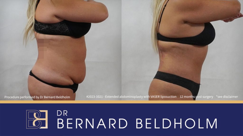 Patient 2023-1021 Extended Abdominoplasty Post Weight Loss with VASER Liposuction and Diastasis Recti Repair | 12 Months Post Surgery - Side