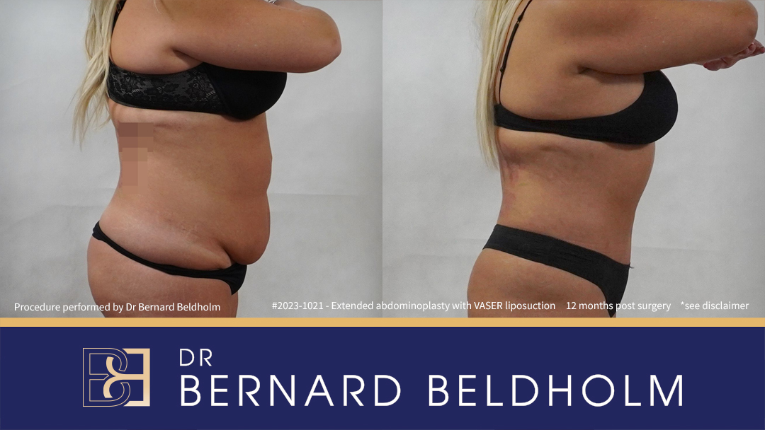 Patient 2023-1021 Extended Abdominoplasty Post Weight Loss with VASER Liposuction and Diastasis Recti Repair | 12 Months Post Surgery - Side Patient 2023-1021 Extended Abdominoplasty Post Weight Loss with VASER Liposuction and Diastasis Recti Repair | 12 Months Post Surgery - Side