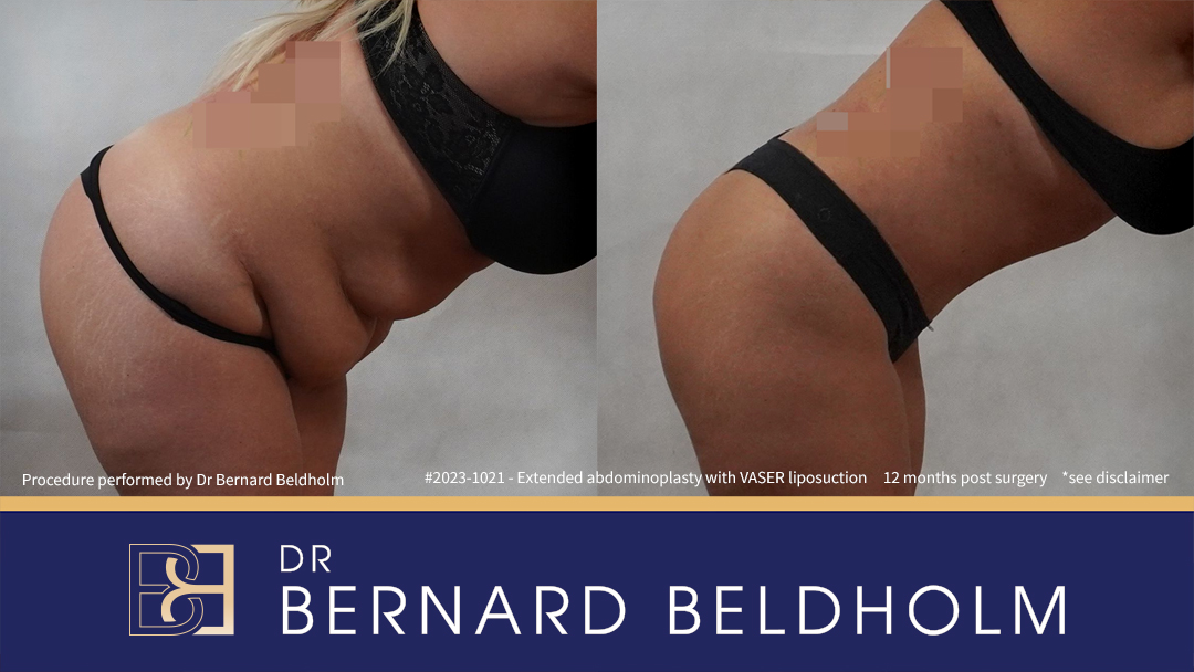 DrBB_Website_-_Patient_2023-1021_-_Extended_abdominoplasty_with_VASER_liposuction_4 Patient 2023-1021 Extended Abdominoplasty Post Weight Loss with VASER Liposuction and Diastasis Recti Repair | 12 Months Post Surgery - Bend