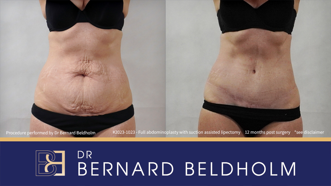 Patient 2023-1023 Full Abdominoplasty Post Pregnancy: Repair Femoral Hernia & Diastasis Recti - Front
