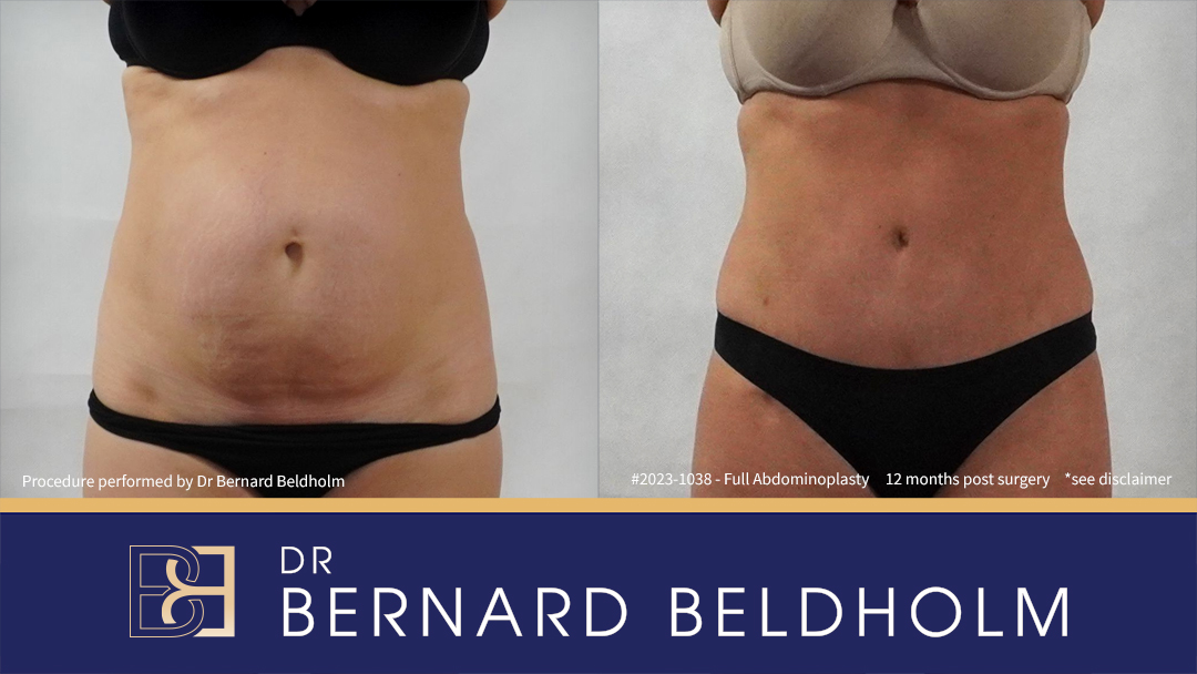 Patient 2023-1038 Full abdominoplasty with VASER liposuction and diastasis recti repair | 12 months post surgery Front