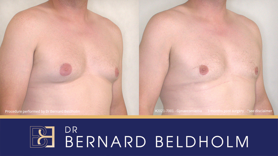 Gynaecomastia Surgery Patient 2021-7001 1 Patient 2021-7001 Grade BB 2b Pseudo-gynaecoamstia with Small Gland Component - Left