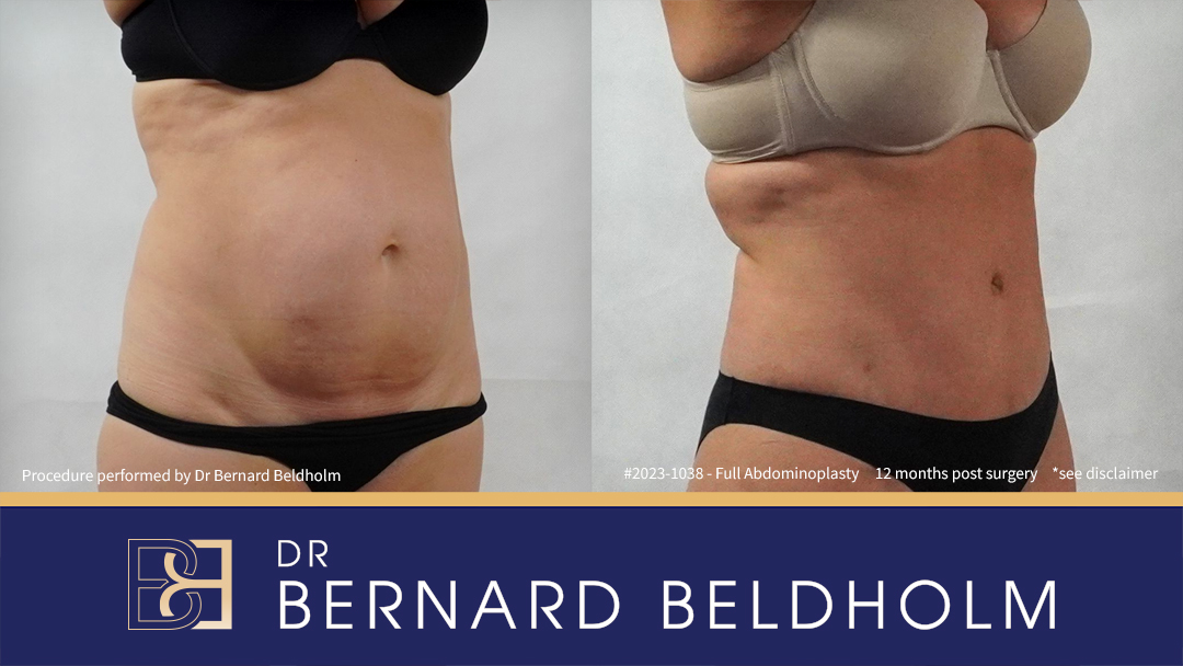 Abdominoplasty Post Pregnancy Patient 2023-1038 1 Patient 2023-1038 Full abdominoplasty with VASER liposuction and diastasis recti repair | 12 months post surgery Left
