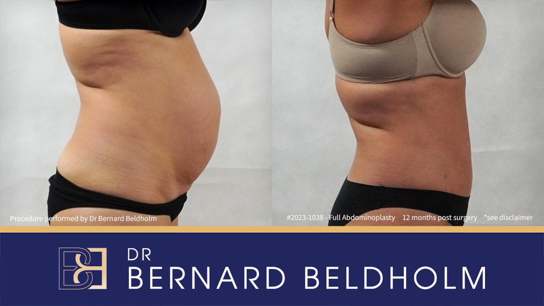 Patient 2023-1038 Full abdominoplasty with VASER liposuction and diastasis recti repair | 12 months post surgery Side Patient 2023-1038 Full abdominoplasty with VASER liposuction and diastasis recti repair | 12 months post surgery Side