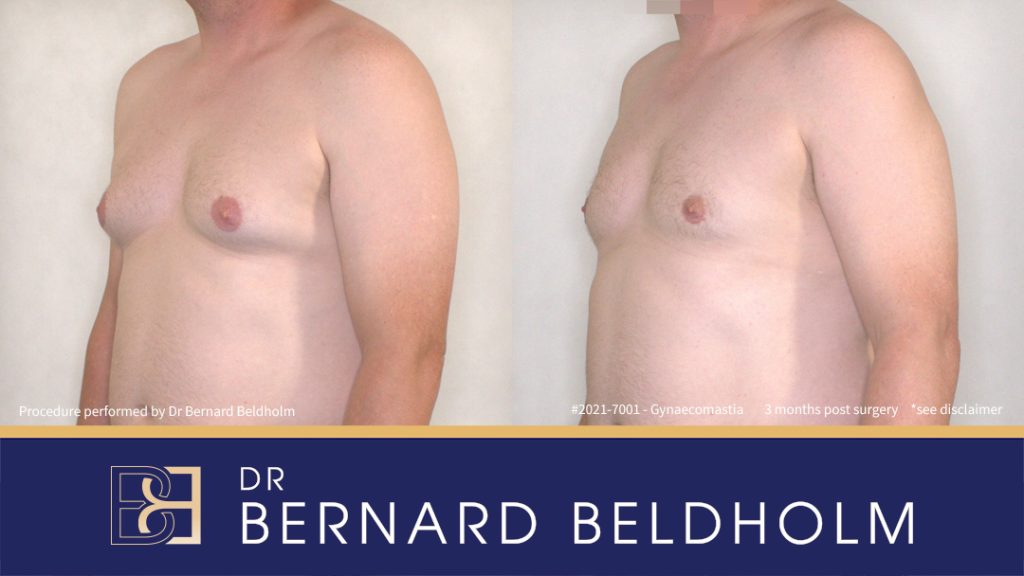 Gynaecomastia Surgery Patient 2021-7001 2 Patient 2021-7001 Grade BB 2b Pseudo-gynaecoamstia with Small Gland Component - Right