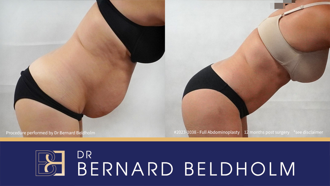 Patient 2023-1038 Full abdominoplasty with VASER liposuction and diastasis recti repair | 12 months post surgery Bend Patient 2023-1038 Full abdominoplasty with VASER liposuction and diastasis recti repair | 12 months post surgery Bend