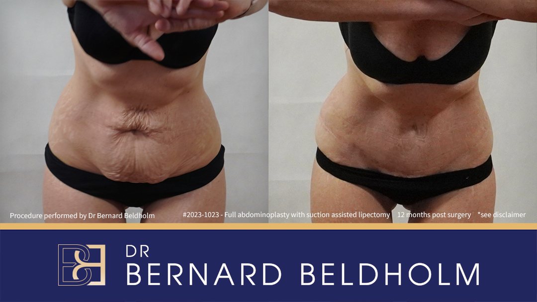 Patient 2023-1023 Full Abdominoplasty Post Pregnancy: Repair Femoral Hernia & Diastasis Recti - Bend