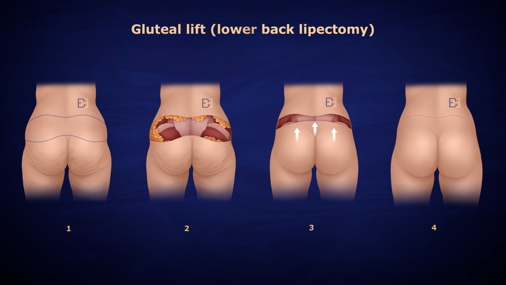 Recovering from Lower Torso Surgery After Significant Weight Loss 8 Lower Back Lipectomy (gluteoplasty)