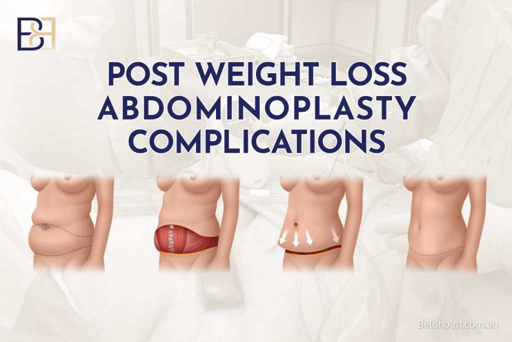 Post Weight Loss Abdominoplasty Complications