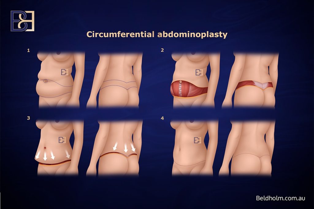 Circumferential Lipectomy