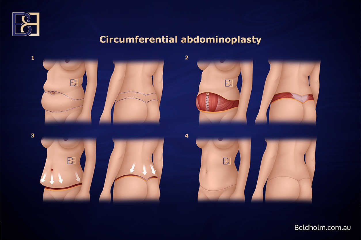 Circumferential Lipectomy