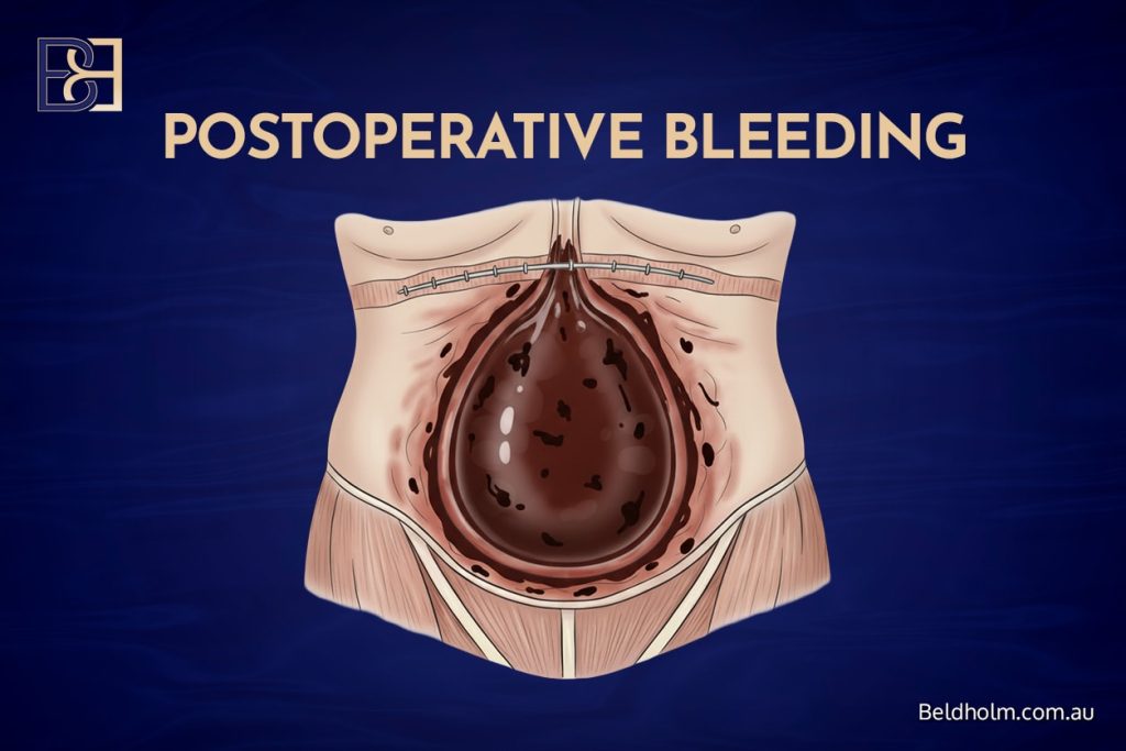 Haematoma and Postoperative Bleeding