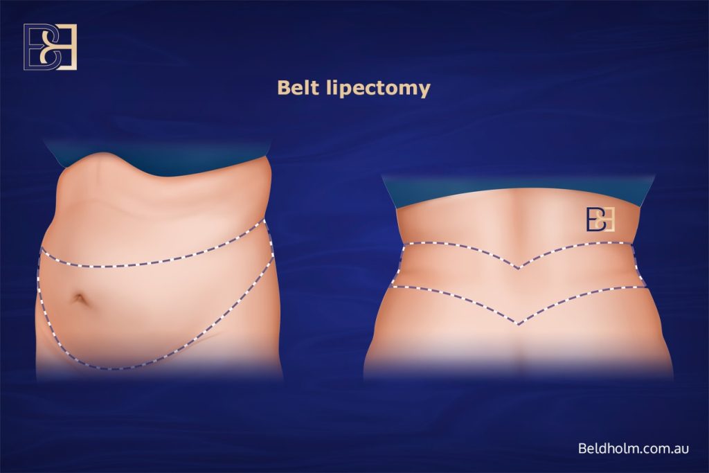 Recovering from Lower Torso Surgery After Significant Weight Loss 6 Circumferential Lipectomy (Belt Lipectomy)
