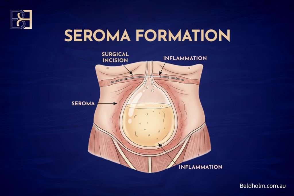 Seroma Formation
