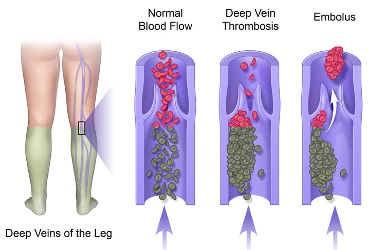 Complications from Lower Torso Operations Post Weight Loss 5 Deep vein thrombosis (DVT) Illustration