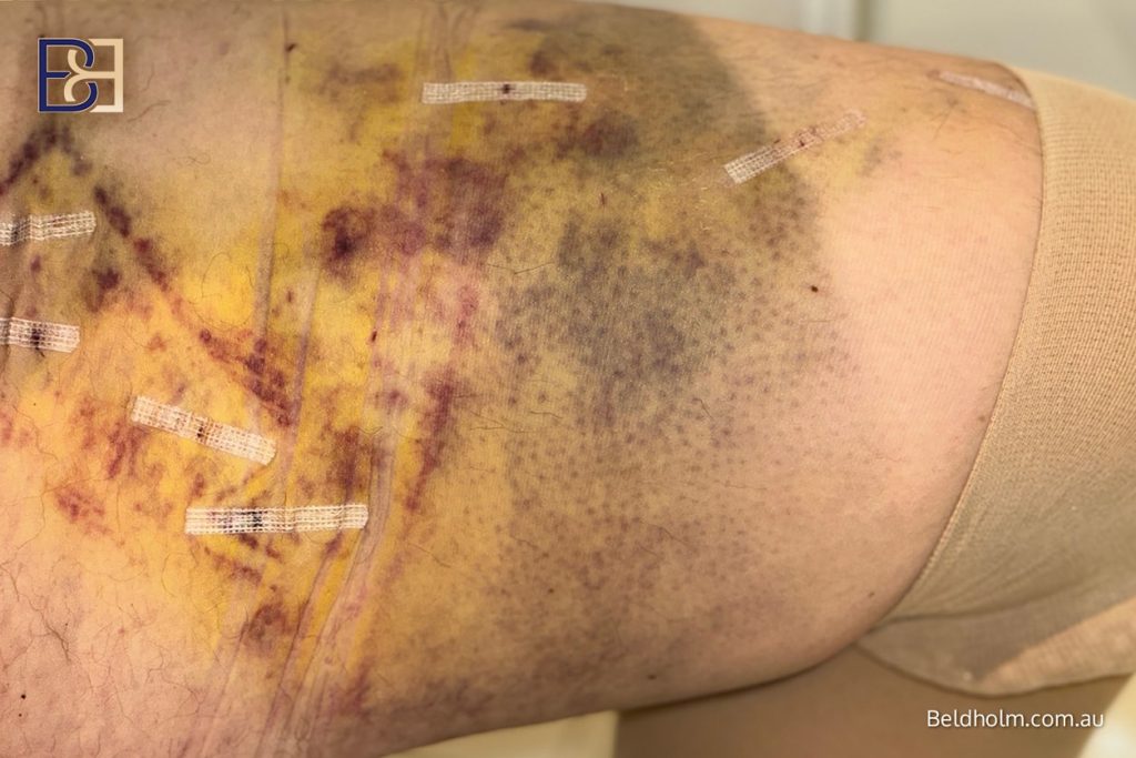 Complications from Lower Torso Operations Post Weight Loss 6 Bruising after surgery